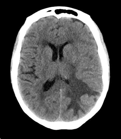 File:Cerebral metastasis (Radiopaedia 46744-51247 Axial non-contrast 17).png