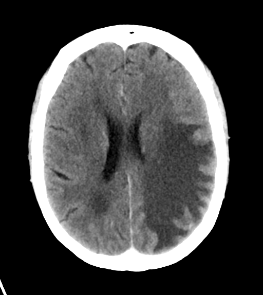 File:Cerebral metastasis (Radiopaedia 46744-51260 Axial C+ delayed 19).png