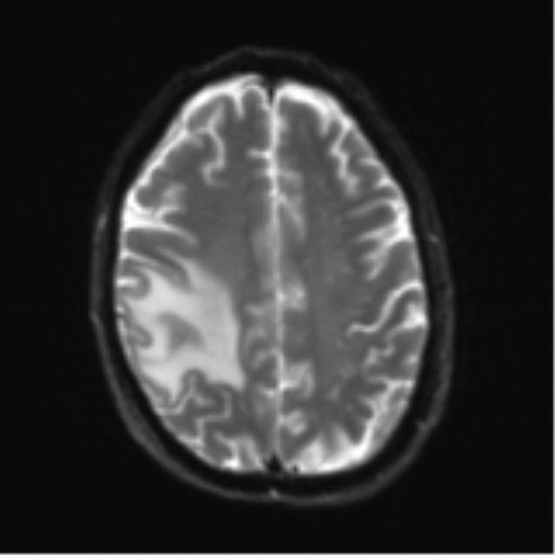 Cerebral metastasis - melanoma (Radiopaedia 54718-60954 Axial DWI 22).png