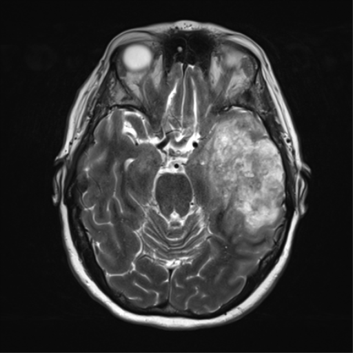 File:Cerebral metastasis mimicking glioblastoma (Radiopaedia 69155-78937 Axial T2 15).png