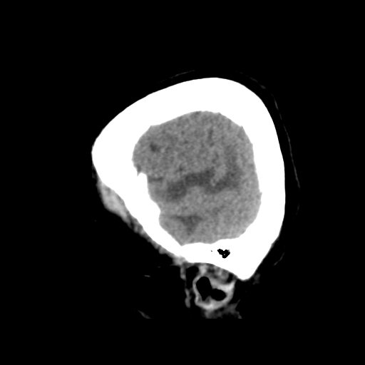 Cerebral metastasis to basal ganglia (Radiopaedia 81568-95412 E 11).png