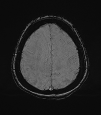 File:Cerebral metastasis to basal ganglia (Radiopaedia 81568-95413 Axial SWI 70).png