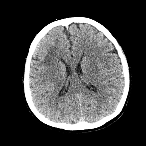 Cerebral ring enhancing lesions - cerebral metastases (Radiopaedia 44922-48818 Axial non-contrast 40).jpg