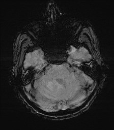 File:Cerebral toxoplasmosis (Radiopaedia 43956-47461 Axial SWI 11).jpg