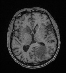 File:Cerebral toxoplasmosis (Radiopaedia 43956-47461 Axial T1 40).jpg