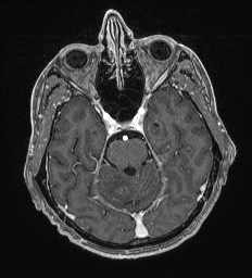 Cerebral toxoplasmosis (Radiopaedia 43956-47461 Axial T1 C+ 22).jpg