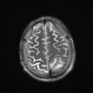 File:Cerebral toxoplasmosis (Radiopaedia 43956-47461 Axial T2 19).jpg