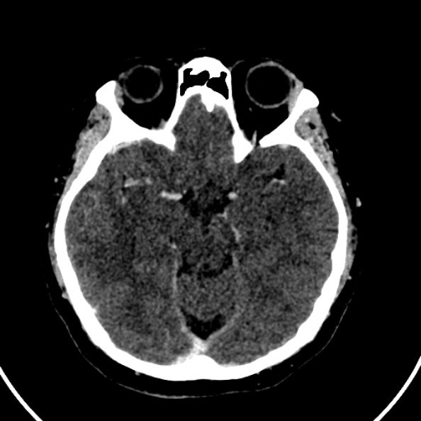 File:Cerebral venous hemorrhagic infarct from venous sinus thrombosis (Radiopaedia 55433-61883 Axial C+ delayed 93).jpg