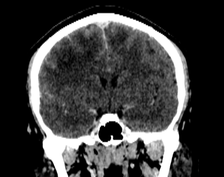 Cerebral venous hemorrhagic infarct from venous sinus thrombosis (Radiopaedia 55433-61883 Coronal C+ delayed 31).jpg