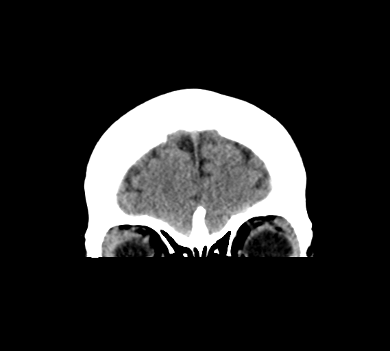 File:Cerebral venous infarct related to dural venous sinus thromboses (Radiopaedia 35292-36804 Coronal non-contrast 5).png