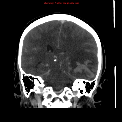 Cerebral venous infarction (Radiopaedia 12404-20735 B 49).jpg