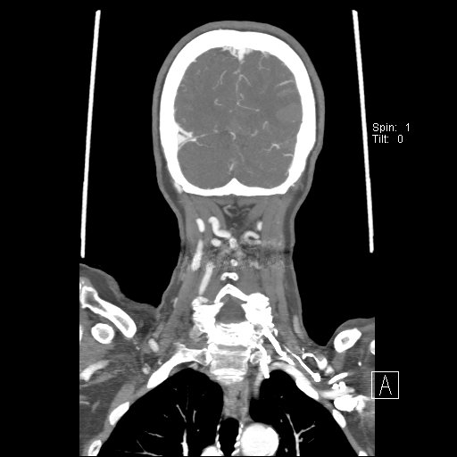 Cerebral venous infarction with hemorrhage (Radiopaedia 65343-74396 B 227).jpg