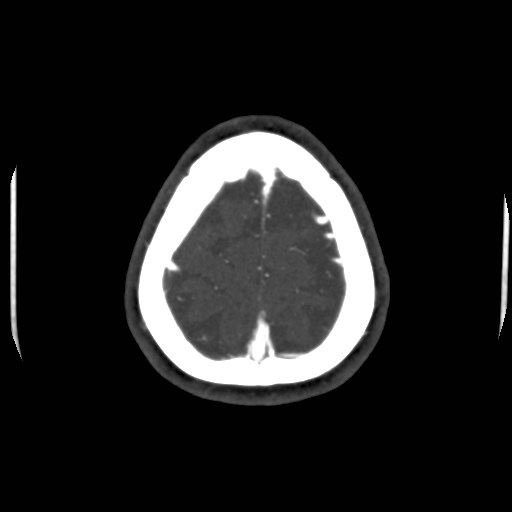 Cerebral venous sinus thrombosis (Radiopaedia 40619-43227 A 207).jpg