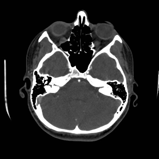 Cerebral venous sinus thrombosis (Radiopaedia 40619-43227 A 57).jpg