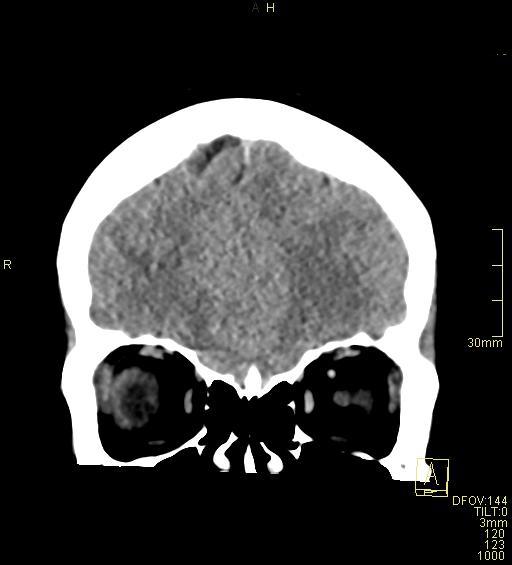 Cerebral venous sinus thrombosis (Radiopaedia 91329-108965 Coronal non-contrast 11).jpg