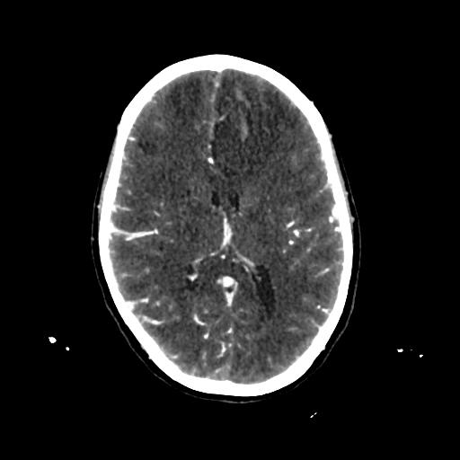 File:Cerebral venous throbmosis - hemorrhagic venous infarction (Radiopaedia 87318-103613 Axial CT venogram 19).jpg