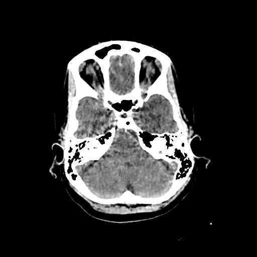 Cerebral venous throbmosis - hemorrhagic venous infarction (Radiopaedia 87318-103613 Axial non-contrast 37).jpg