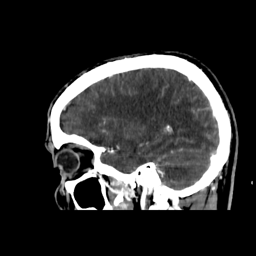 File:Cerebral venous thrombosis (CVT) (Radiopaedia 77524-89685 Sagittal CTV 33).jpg