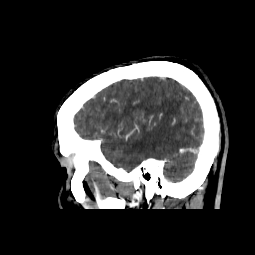 File:Cerebral venous thrombosis (CVT) (Radiopaedia 77524-89685 Sagittal CTV 39).jpg