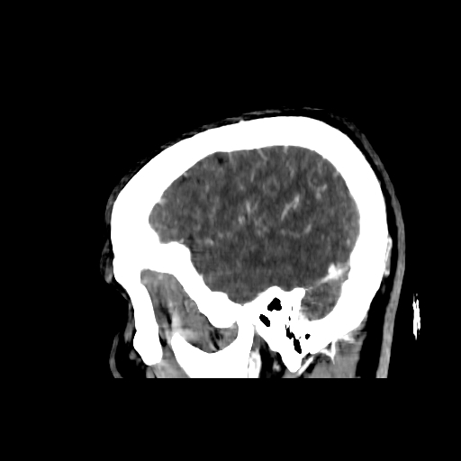 File:Cerebral venous thrombosis (CVT) (Radiopaedia 77524-89685 Sagittal CTV 41).jpg