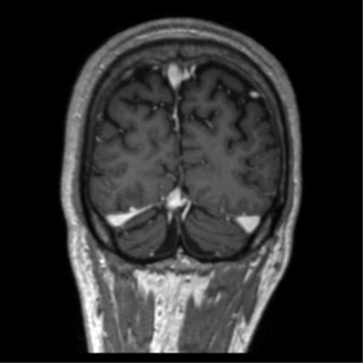 Cerebral venous thrombosis (Radiopaedia 38392-40469 Coronal T1 C+ 13).png