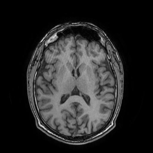 Cerebral venous thrombosis with secondary intracranial hypertension (Radiopaedia 89842-106957 Axial T1 100).jpg