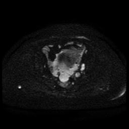 Cervical carcinoma (Radiopaedia 85405-101028 Axial DWI 52).jpg
