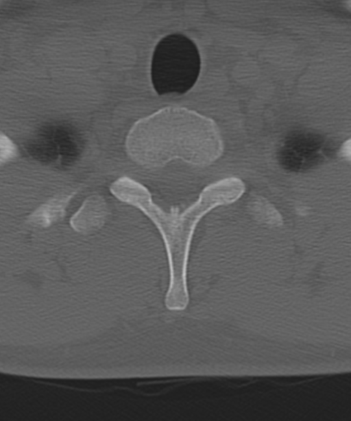 Cervical intercalary bone (Radiopaedia 35211-36748 Axial bone window 60).png