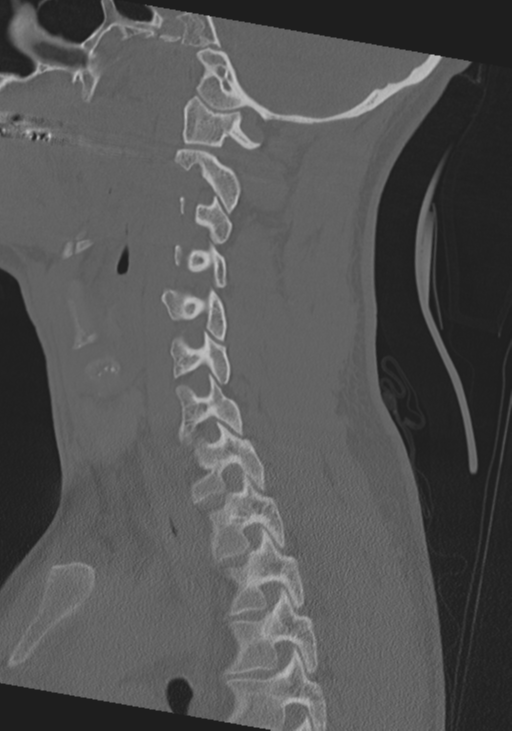 Cervical intercalary bone (Radiopaedia 35211-36748 Sagittal bone window 30).png
