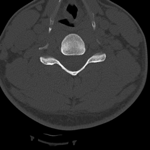 File:Cervical schwannoma (Radiopaedia 57979-64974 Axial bone window 29).png