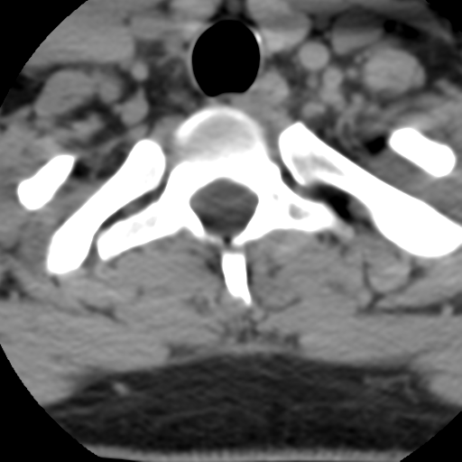 Cervical schwannoma (Radiopaedia 57979-64974 Axial non-contrast 58).png