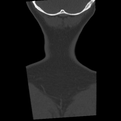 Cervical schwannoma (Radiopaedia 57979-64974 Coronal bone window 59).png