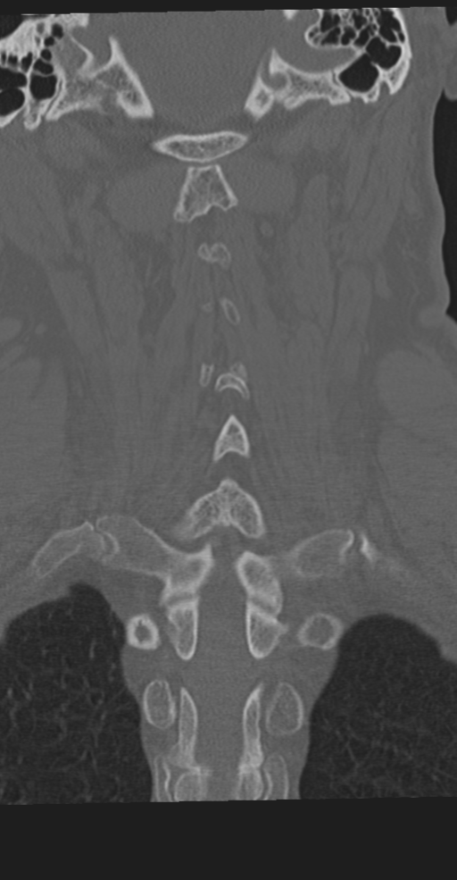 Cervical spine fracture in the setting of ankylosis (Radiopaedia 37038-38715 Coronal bone window 49).png