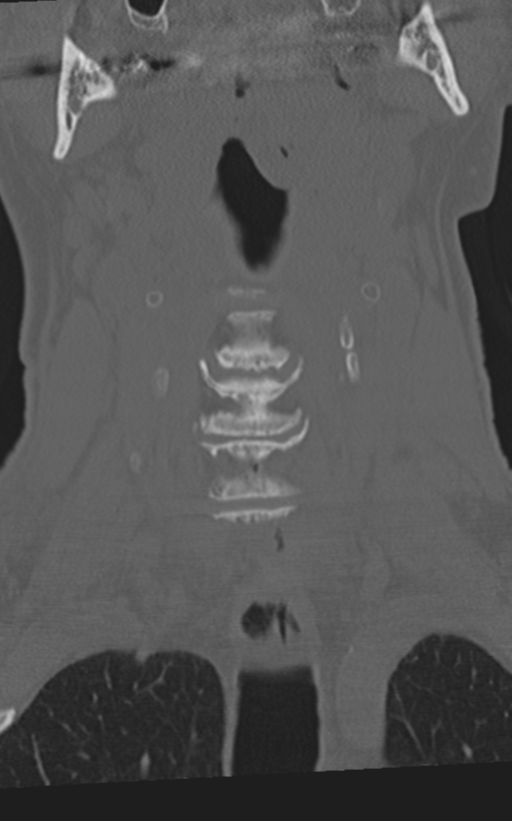 Cervical spine fractures with vertebral artery dissection (Radiopaedia 53296-59268 Coronal bone window 17).png