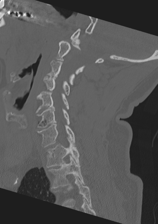 Cervical spine fractures with vertebral artery dissection (Radiopaedia 53296-59268 Sagittal bone window 42).png