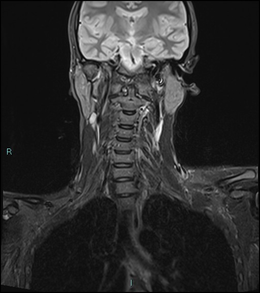 File:Cervical thymic cyst (Radiopaedia 88632-105336 Coronal STIR 24).jpg