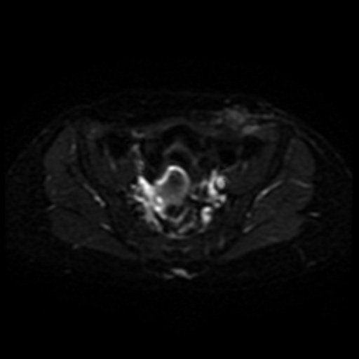 File:Cesarian section scar endometriosis (Radiopaedia 66520-75799 Axial DWI 8).jpg