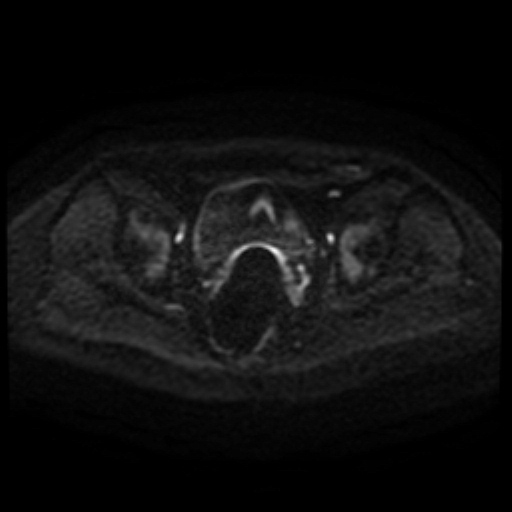 Cesarian section scar endometriosis (Radiopaedia 66520-75799 Axial DWI 90).jpg