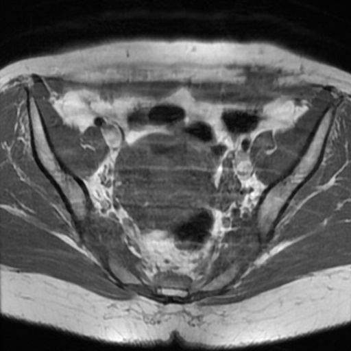 File:Cesarian section scar endometriosis (Radiopaedia 66520-75799 Axial T1 8).jpg