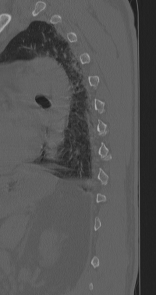 Chance fracture (Radiopaedia 33854-35020 Sagittal bone window 20).png