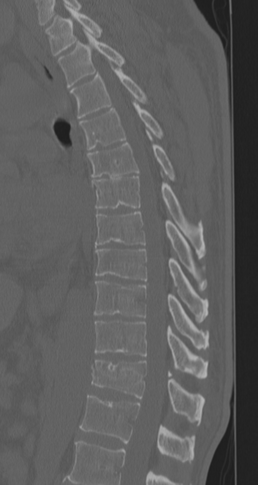 Chance fracture (Radiopaedia 33854-35020 Sagittal bone window 42).png