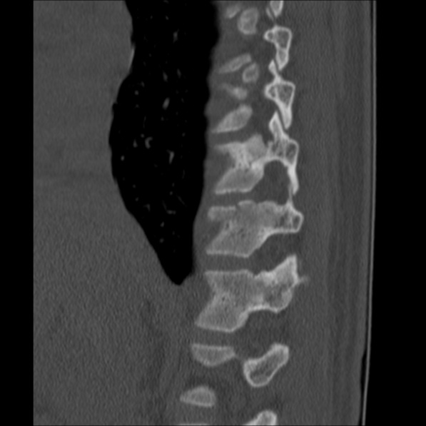 Chance fracture (Radiopaedia 36521-38081 Sagittal bone window 16).jpg