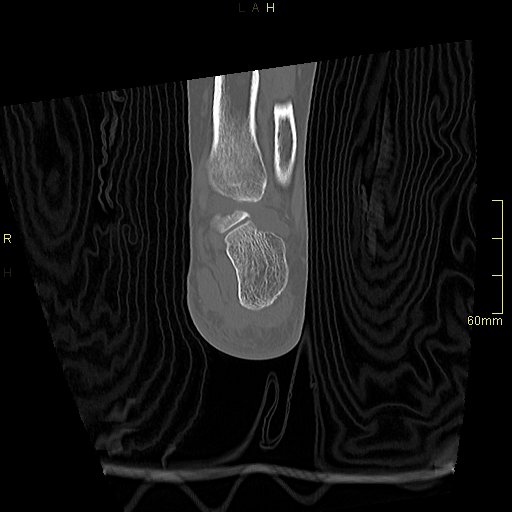 Chaput tubercle fracture (Radiopaedia 80319-93956 Coronal non-contrast 48).jpg