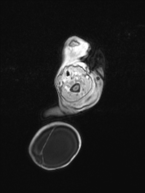 Chiari III malformation with occipital encephalocele (Radiopaedia 79446-92559 Axial T1 C+ mpr 15).jpg