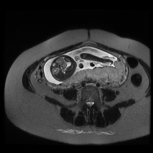 Chiari II malformation - fetal MRI (Radiopaedia 68099-77581 Axial T2-SSFSE 19).jpg