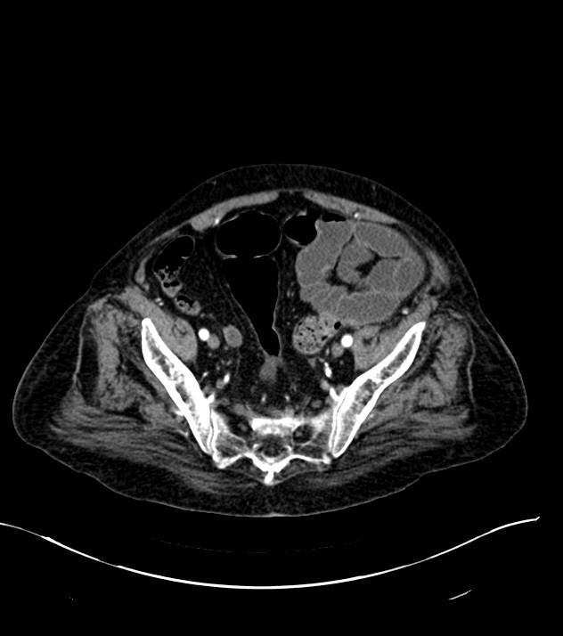 Cholangiocarcinoma with cerebral metastases (Radiopaedia 83519-98629 B 101).jpg