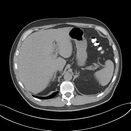 Cholecystitis with focal perforation and hepatic abscess (Radiopaedia 37189-38945 Axial non-contrast 19).png
