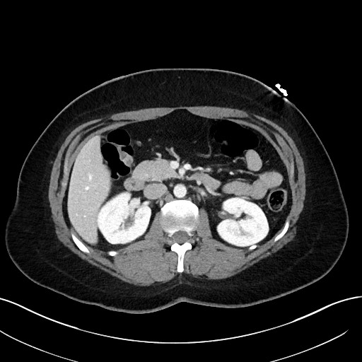 File:Choledocholithiasis after recent cholecystectomy (Radiopaedia 60929-68737 Axial 17).jpg