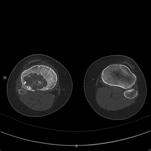 Chondroblastoma (Radiopaedia 62721-71030 Axial bone window 61).jpg