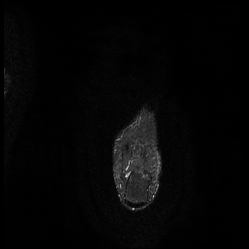 File:Chondroblastoma - midfoot (Radiopaedia 64831-73765 Long axis T2 fat sat 3).jpg